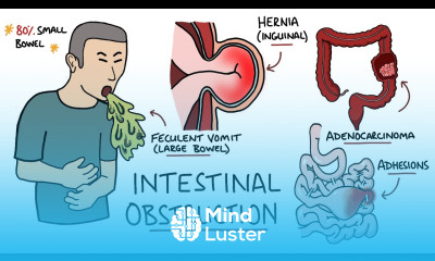 Intestinal Obstruction Small Bowel Obstruction vs Large Bowel Obstruction