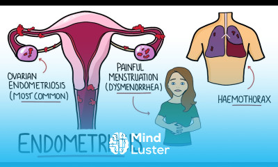 Endometriosis Explained Signs Symptoms Diagnosis Pathology Treatment