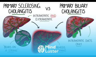 Primary Sclerosing Cholangitis v Primary Biliary Cholangitis Primary Biliary Cirrhosis