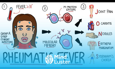 Rheumatic Fever Made Easy Including Jones Criteria and Mnemonic