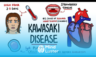 Kawasaki Disease Explained Includes Criteria Mnemonic
