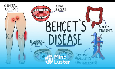 Behcets Disease Signs and Symptoms with Triad Pathophysiology Criteria Treatment