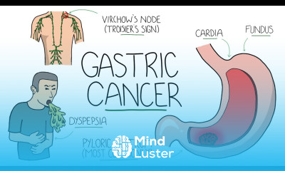 Gastric Cancer An Overview for Students and Junior Doctors Including Troisier s Sign