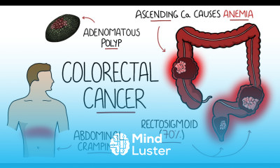 Understanding Colorectal Cancer Includes Polyps
