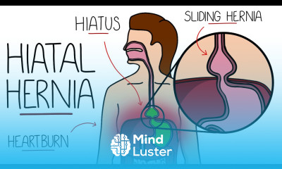 Hiatal Hernia Explained Hiatus Hernia