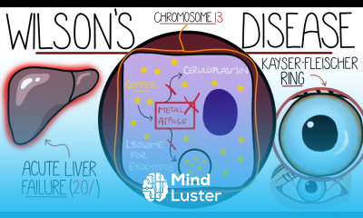 Understanding Wilson s Disease Hepatolenticular Degeneration