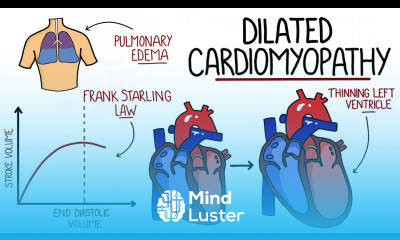 Dilated Cardiomyopathy Made Easy DCM
