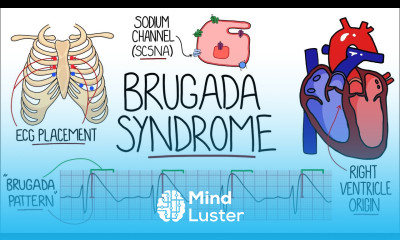 Brugada Syndrome Explained Includes ECG Sudden Unexplained Nocturnal Death Syndrome