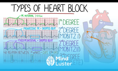 Heart Blocks Made Easy 1st 2nd Mobitz 1 Wenckebach Mobitz 2 3rd Complete with ECGs