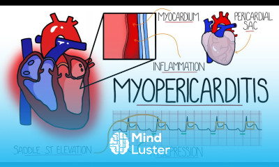 Myocarditis Pericarditis Myopericarditis Explained