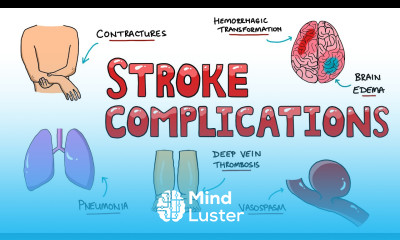 Post Stroke Complications What are the most common complications of stroke