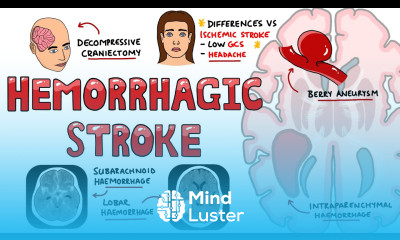 Hemorrhagic Stroke Intracerebral Hemorrhage Subarachnoid Hemorrhage Management