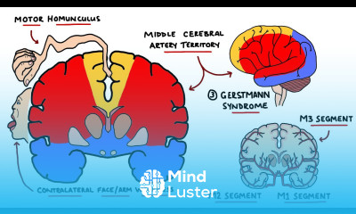 Middle Cerebral Artery Stroke Syndromes MCA Stroke Syndromes With Gerstmann Syndrome Lesions