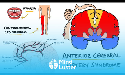 Anterior Cerebral Artery Stroke Syndrome ACA Stroke Syndrome Stroke Syndromes