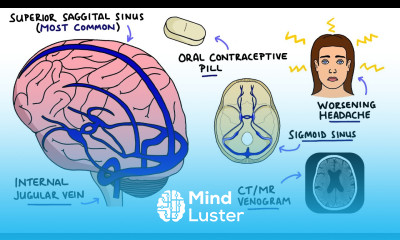 Cerebral Venous Sinus Thrombosis CVST With Dural Venous Sinuses Anatomy