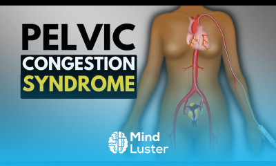 What Is Pelvic Congestion Syndrome