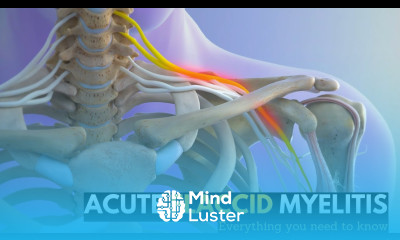 Acute Flaccid Myelitis Everything You Need To Know