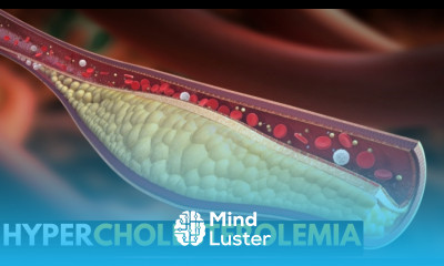 Hypercholesterolemia Everything You Need to Know