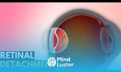 Retinal Detachment Everything You Need To Know