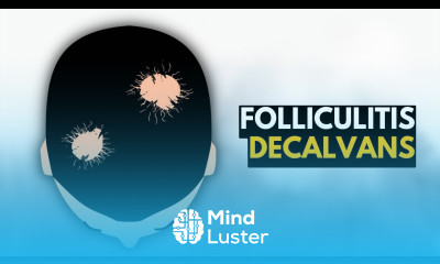 Folliculitis Decalvans What You Need To Know