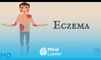 Eczema Everything You Need To Know
