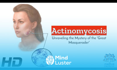 Actinomycosis Unleashed The Journey to Expose the Great Masquerade