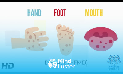 Hand Foot and Mouth Disease Causes Signs and Symptoms Diagnosis and Treatment