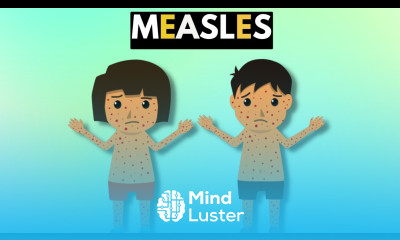 Measles Causes Signs and Symptoms Diagnosis and Treatment