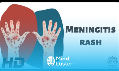 Meningitis Rash Everything You Need Know