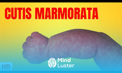 What is Cutis Marmorata