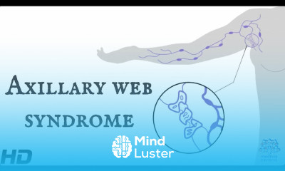Axillary Web Syndrome Everything You Need To Know