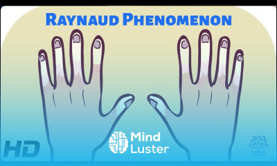 Blue Fingers and Toes Understanding Raynaud Phenomenon