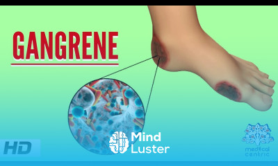 Gangrene Causes Signs and Symptoms Diagnosis and Treatment