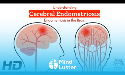 Cerebral Endometriosis Decoding the Complexities