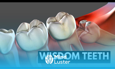 Wisdom teeth Causes Symptoms and Treatment