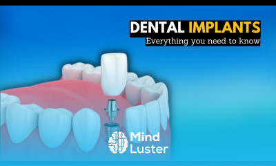 The Ultimate Guide to Dental Implants Change Your Smile Forever