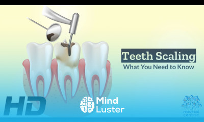 Teeth Scaling From Tartar Trouble to Pearly Whites