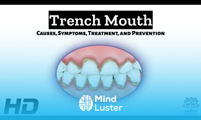 Decoding Trench Mouth Causes Symptoms and Prevention