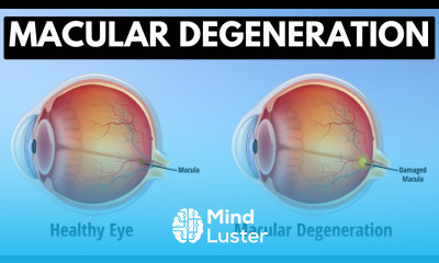 Macular degeneration Causes Signs and Symptoms Diagnosis and Treatment