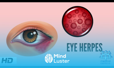 Eye Herpes Causes Signs and Symptoms Diagnosis and Treatment