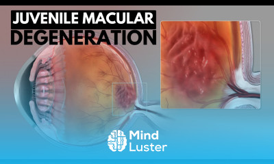 Juvenile Macular Degeneration Causes Symptoms and Treatment