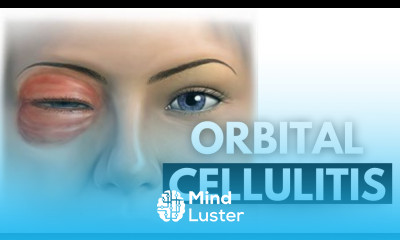 Orbital Cellulitis A Comprehensive Guide to Diagnosis and Management