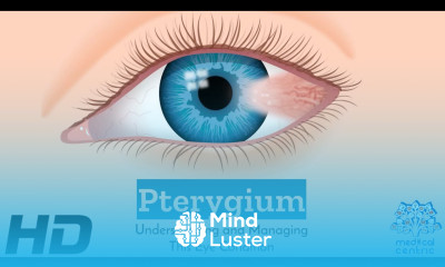 Eyes on Pterygium How to Protect and Preserve Your Vision