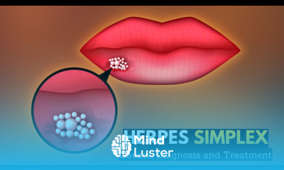 Herpes Simplex Causes Signs and Symptoms Diagnosis and Treatment