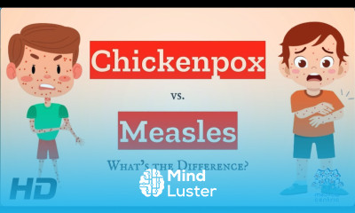 Chickenpox vs Measles Which is Which