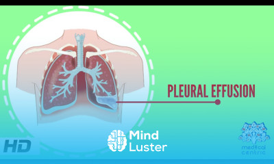 Pleural Effusion Causes Signs and Symptoms Diagnosis and Treatment