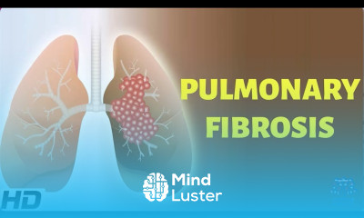 Pulmonary Fibrosis Everything You Need To Know
