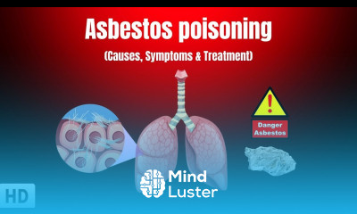 Asbestos Poisoning Causes Symptoms and Treatment