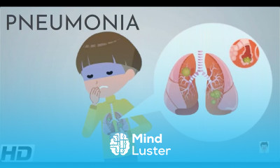 Pneumonia Everything You Need To Know