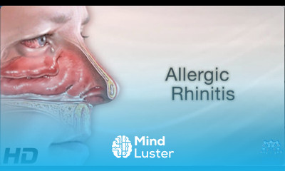 ALLERGIC RHINITIS Everything You Need To Know